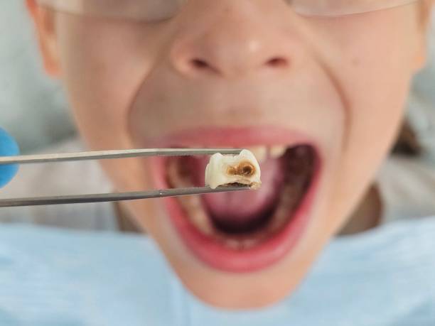 Best Knocked-Out Tooth (Avulsed Tooth) Treatment in Pembroke Pines, FL